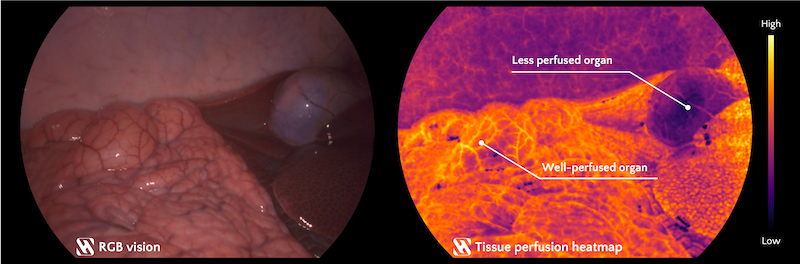 Mock example of how Hypervision's perfusion heatmap imaging technology compares to standard RGB colour images.